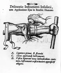 Inyección intravenosa usando una vejiga de clystère. por J. D. Mayor, 