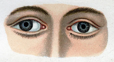 Estrabismo divergente. “La nueva medicación natural” por F.E. Bilz