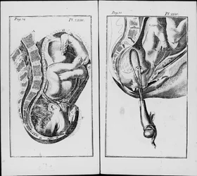 Nacimiento de un bebé con uso de fórceps. Lámina de “Un resumen de la práctica de la obstetricia” de William Smellie (1697-1763)