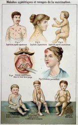 Lámina que ilustra las diferentes formas de las enfermedades sifilíticas y los peligros de la vacunación - en la medicina natural de Bilz, finales del siglo XIX.