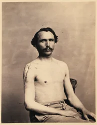 Soldado Adolph Zirsse, escisión intermedia exitosa de la cabeza y dos pulgadas y media del eje del húmero derecho, del catálogo fotográfico de la sección quirúrgica.