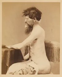Soldado John Bar, Recuperación tras una herida penetrante en el abdomen con fractura del os innominatum izquierdo, del Catálogo Fotográfico de la Sección Quirúrgica.